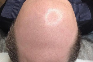 Миноксидил для роста волос, от облысения – отзывы мужчин